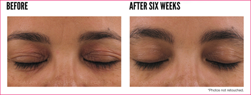 wrinkle reduction beverly hills