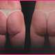 west hollywood cellulite treatments