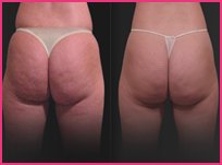 west hollywood cellulite treatments