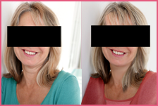 nonsurgical facelift beverly hills
