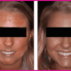 beverly hills acne facial peel